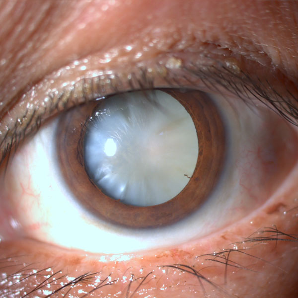 Cirurgia de catarata: maiores expectativas e melhores resultados